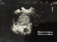 Фото УЗИ на 5 неделе беременности