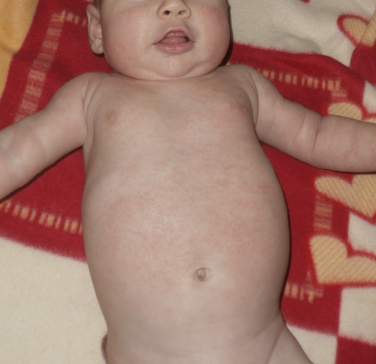 http://www.babyblog.ru/consultant/post/drmtlg/117389