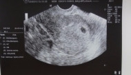 Фото УЗИ на 4 неделе беременности