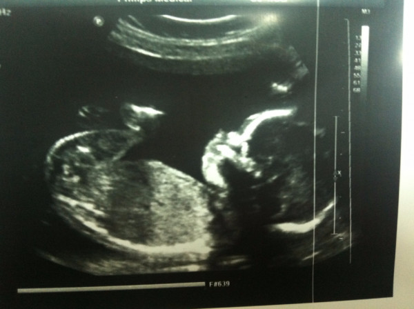 Фото узи беременности 20 недель мальчик