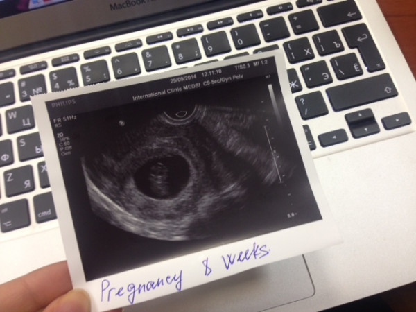 Узи 8 недель беременности фото