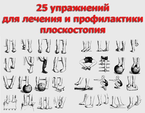 Упражнения при плоскостопии