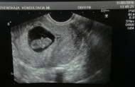 Фото УЗИ на 10 неделе беременности