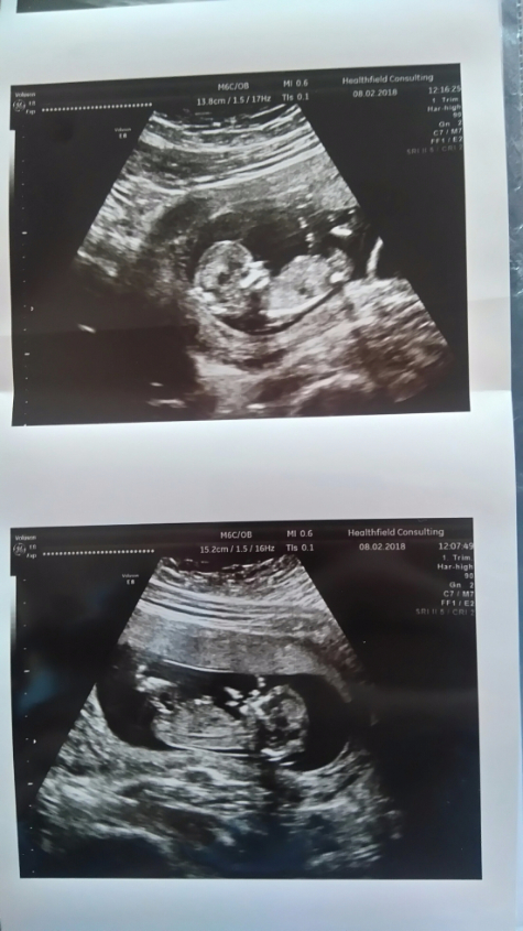 Беременность 12 недель мальчик. УЗИ малыша на 12 неделе. Снимок ребенка на УЗИ 12 недель. Снимки УЗИ на 12 неделе.