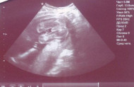 Фото УЗИ на 22 неделе беременности