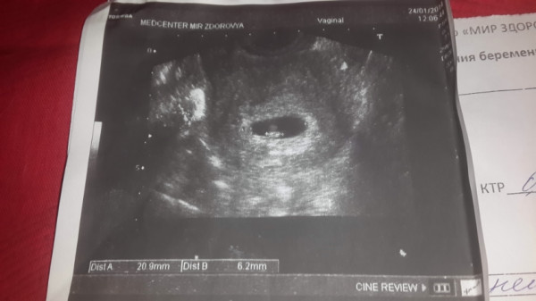Узи 6 месяцев. КТР 2,6 мм. Снимок УЗИ на 2 месяце беременности. Снимки УЗИ 2 месяца беременности.