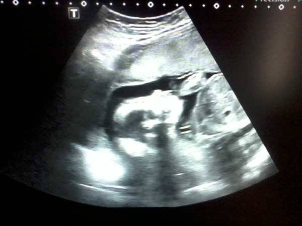 Почему на 21 недели. Снимок УЗИ на 21 неделе беременности. УЗИ 21 неделя беременности мальчик. УЗИ плода 21 неделя беременности. Фото УЗИ ребенка на 21 неделе беременности.
