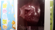 Фото УЗИ на 15 неделе беременности