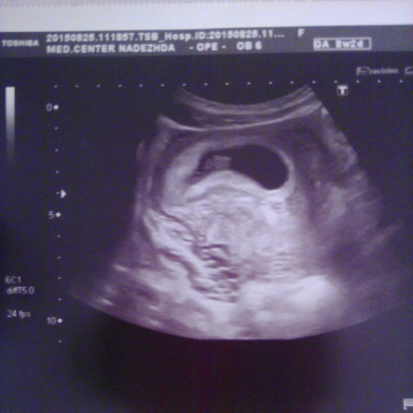 Эмбрион на 8 неделе беременности фото узи