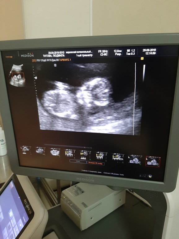 3 скрининг казань. 3 скрининг казань. третий скрининг при беременности нормы. 32 неделя беременности скрининг узи. ультразвуковое исследование плода 1 триместр.