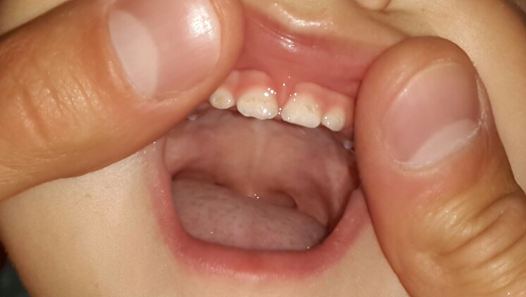 злой кариес(