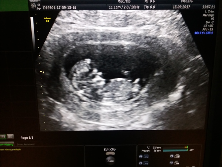 на 1 скрининге можно узнать пол ребенка