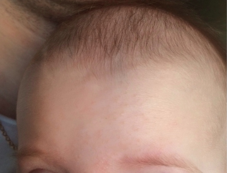 Прыщи на лбу