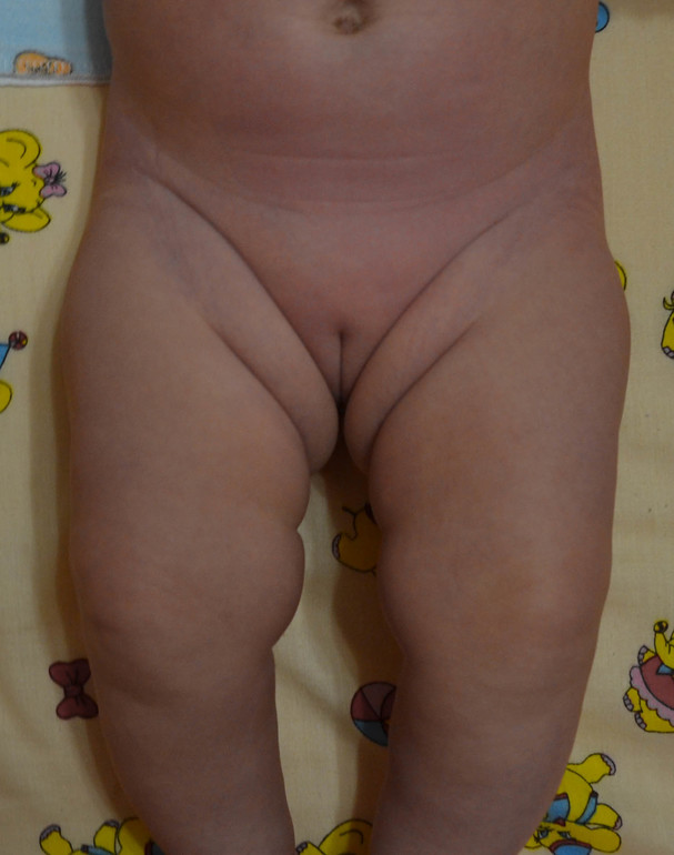 складочки на внутренней стороне