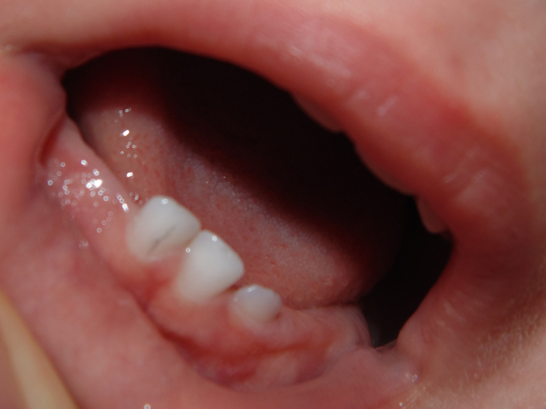 Темная полоса на зубике.