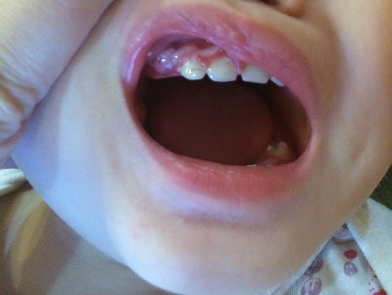 Синдром прорезывания зубов