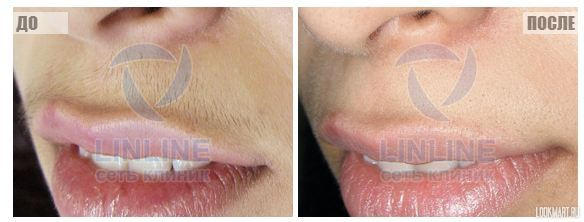 Элос эпиляция в Днепропетровске