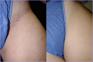 Элос эпиляция в Днепропетровске