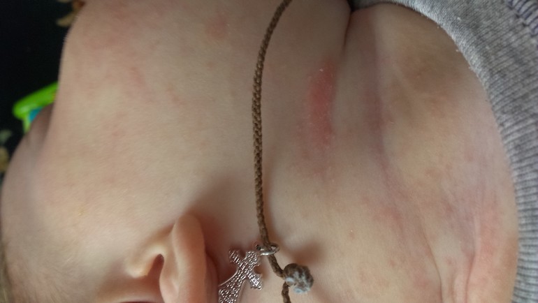 Сыпь. Не могу понять на что