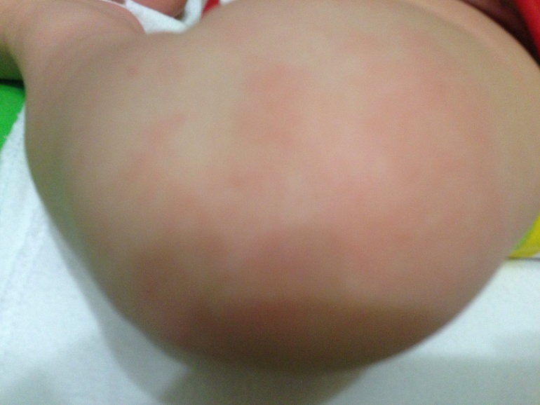 Что за пятна?(( Аллергия ли?