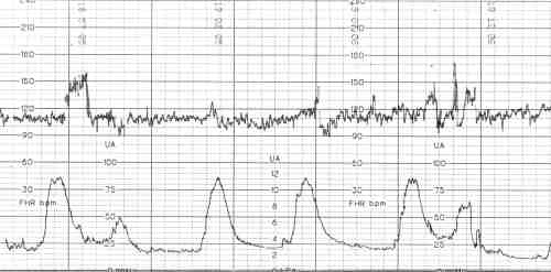 Помогите расшифровать КТГ