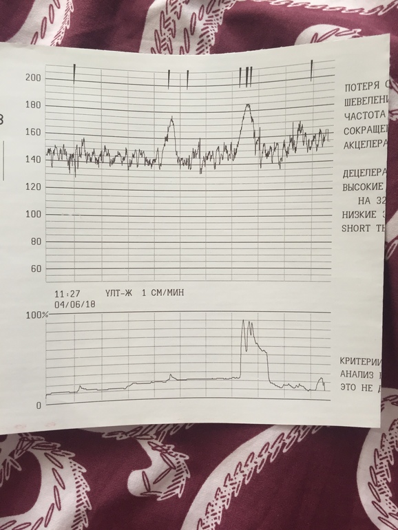 Сердцебиение плода на ктг
