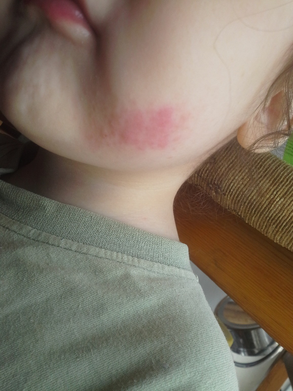 АД после трех лет, усиление аллергии с возрастом, кто столкнулся ?