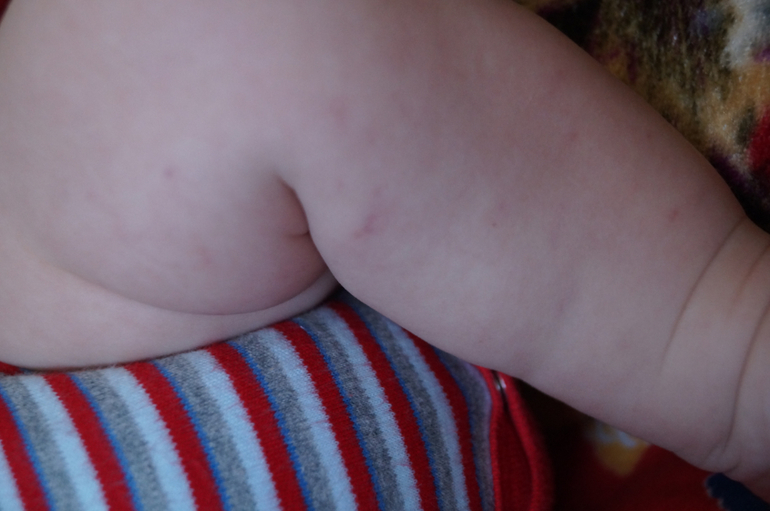 пятна на ножках