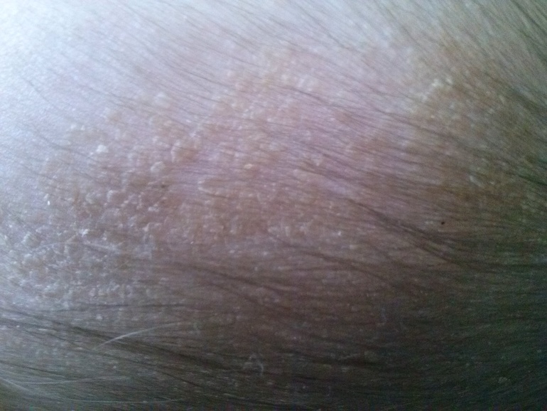 как избавиться от молочной корочки?