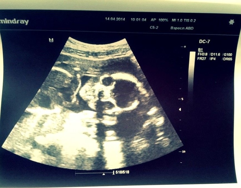 Очередное узи...