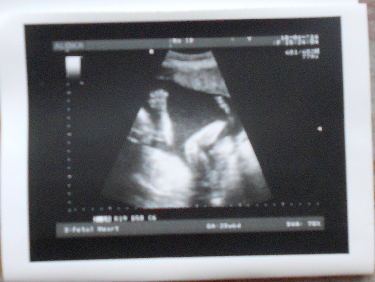 Узи в 22 недели