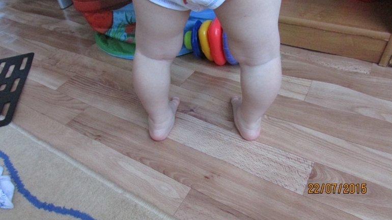 Х образные ноги у ребенка 2 лет фото