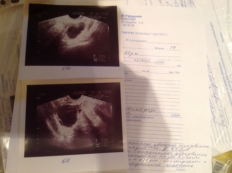 Посмотрите пожалуйста кисты жт или не лопнувшие фоликулы ?