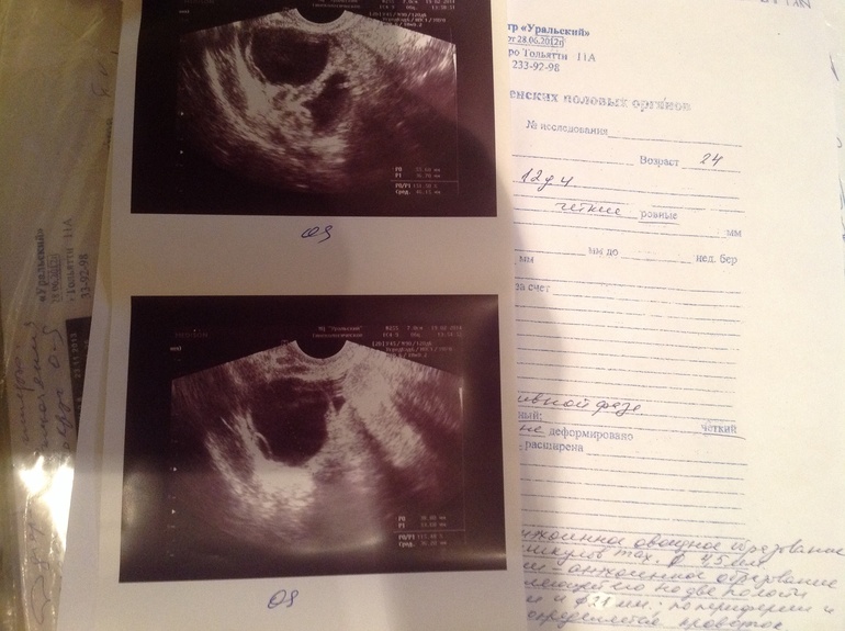 Посмотрите пожалуйста кисты жт или не лопнувшие фоликулы ?