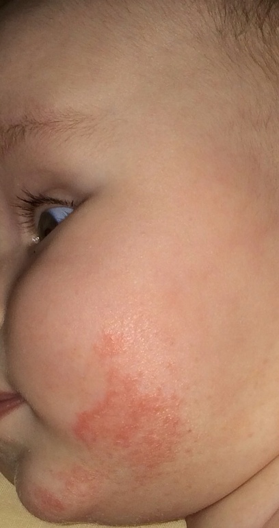 Пятна на щеке ?