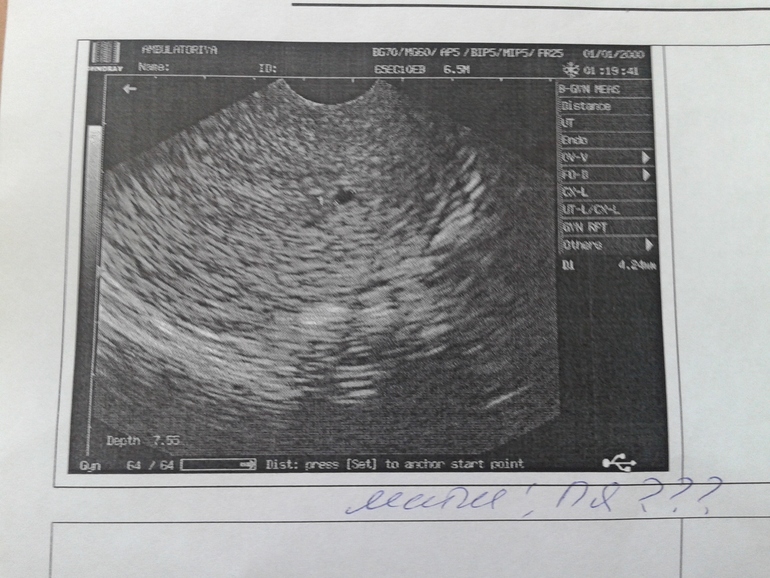 Срочно! Что с моей Беременностью?