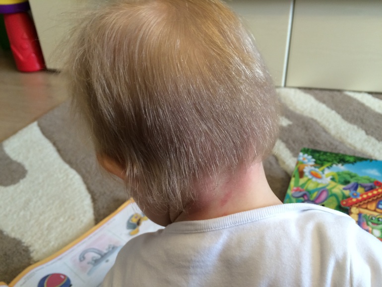 Что делать если у ребенка плохо растут волосы на голове в 4 года