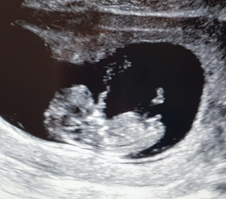 Беременность 12 недель мальчик