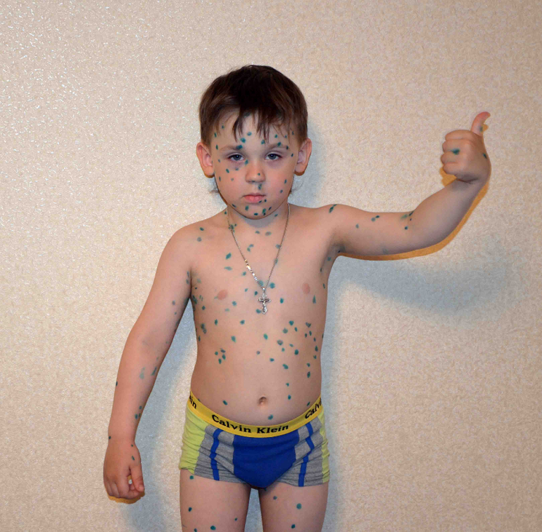 А у нас, а у нас, а у наааас ВЕТРЯНОЧКА!!!!!!