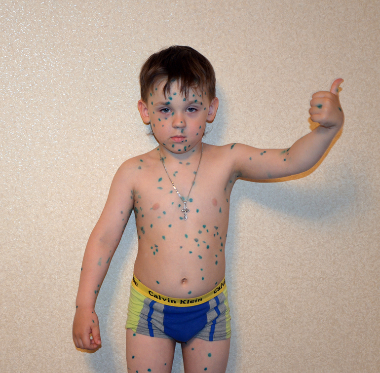 История ветрянки. Гордей.