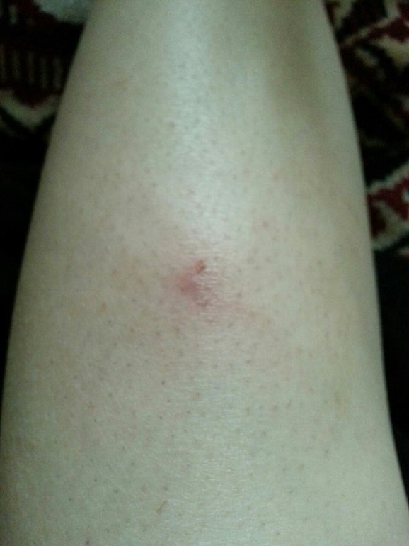 Воспаление ранки