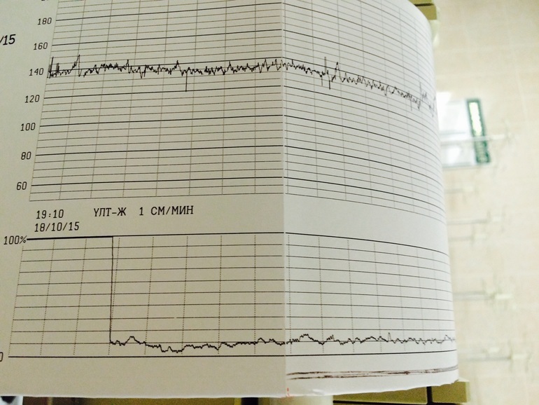 Ктг ребенка. Ребенок спит на КТГ. Ребенок спал на КТГ. На КТГ не шевелится. На КТГ ребенок не шевелится.