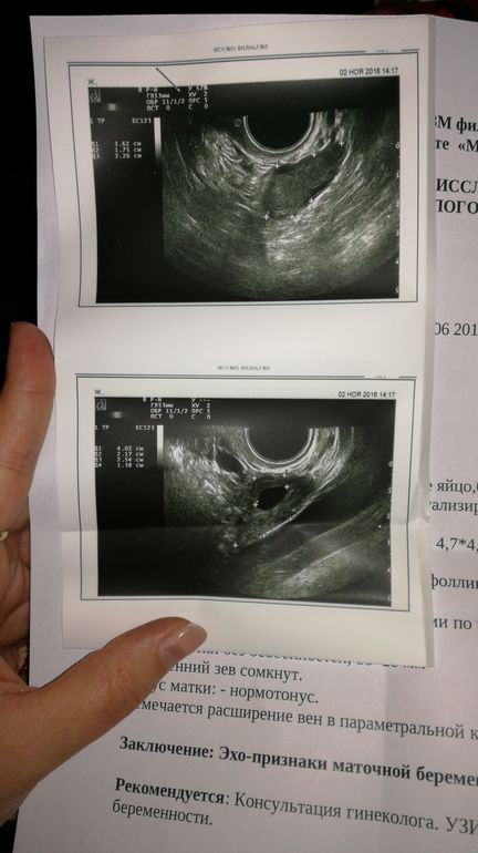 Курс 6 недель. УЗИ 2 на 5-6 недели беременности. УЗИ 2.5 недели беременности фото.