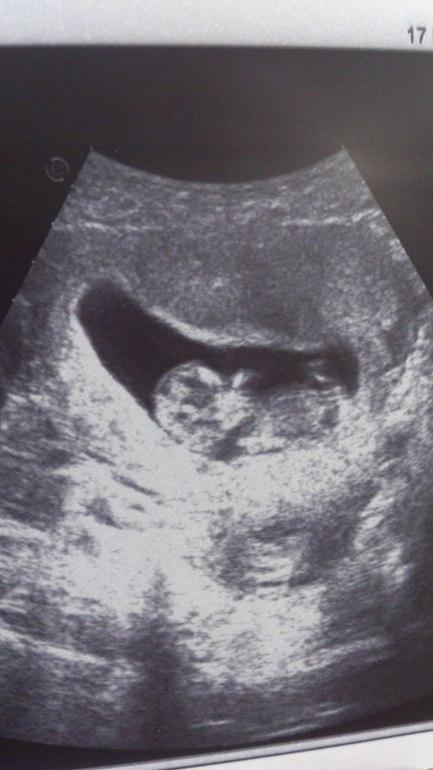 Скрининг первого триместра =)