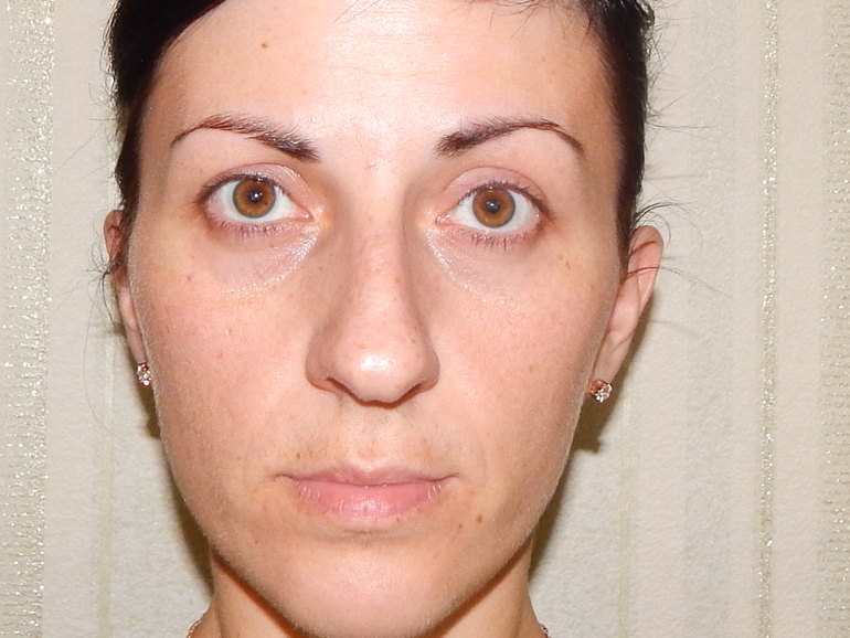 Как можно поменять свою форму глаз и лицо