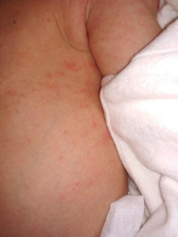Чем смазать аллергию на коже у ребенка: эффективные средства и советы — Статьи об онкологии