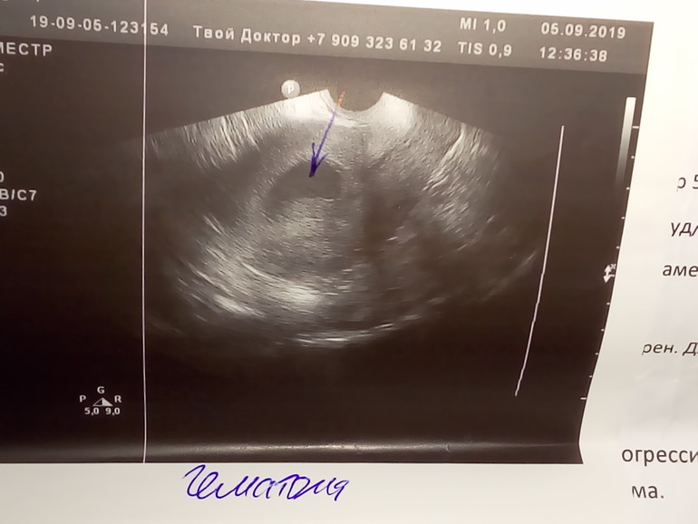 7 неделя беременности акушерская фото узи