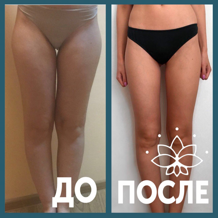 Мой результат похудения на массаже