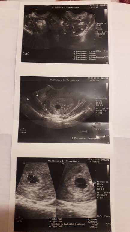 Ретрохориальная гематома. Ретрохориальная гематома на УЗИ 7 недель. Ретрохориальная гематома 8 мм. Ретрохориальная гематома над внутренним зевом. Ретрохориальная гематома в стадии регресса.