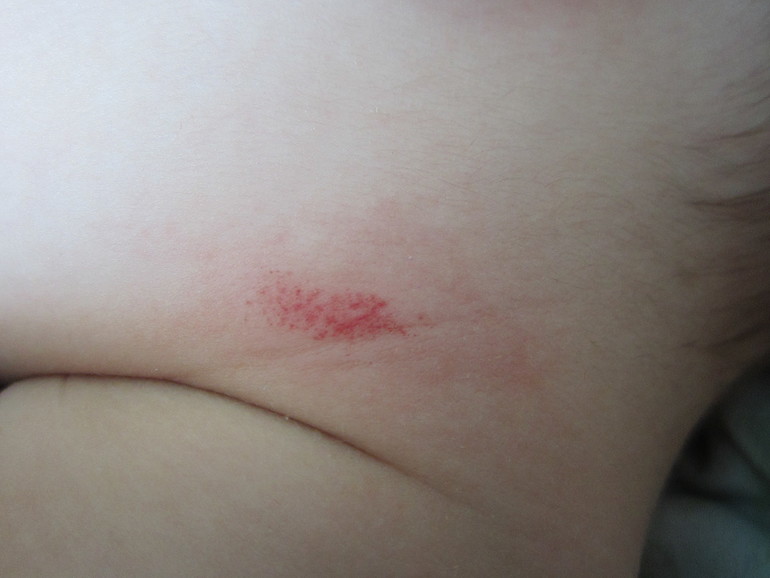 Странное пятно на шее